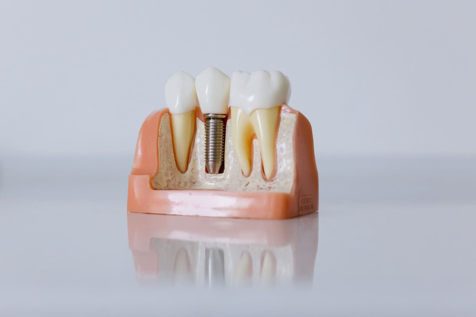 Pemasangan Gigi Palsu yang terlihat alami
